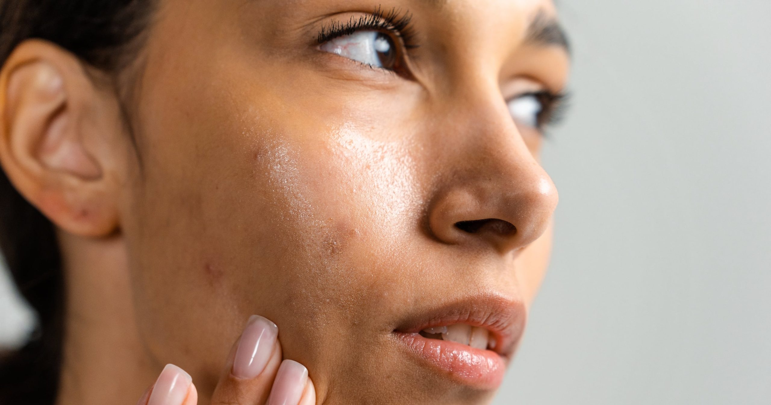 Arbutin Is a Gentle Way to Diminish Dark Spots