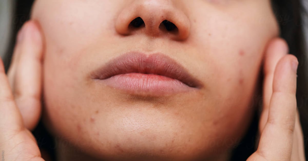 Here's How to Remove Blackheads At Home Safely