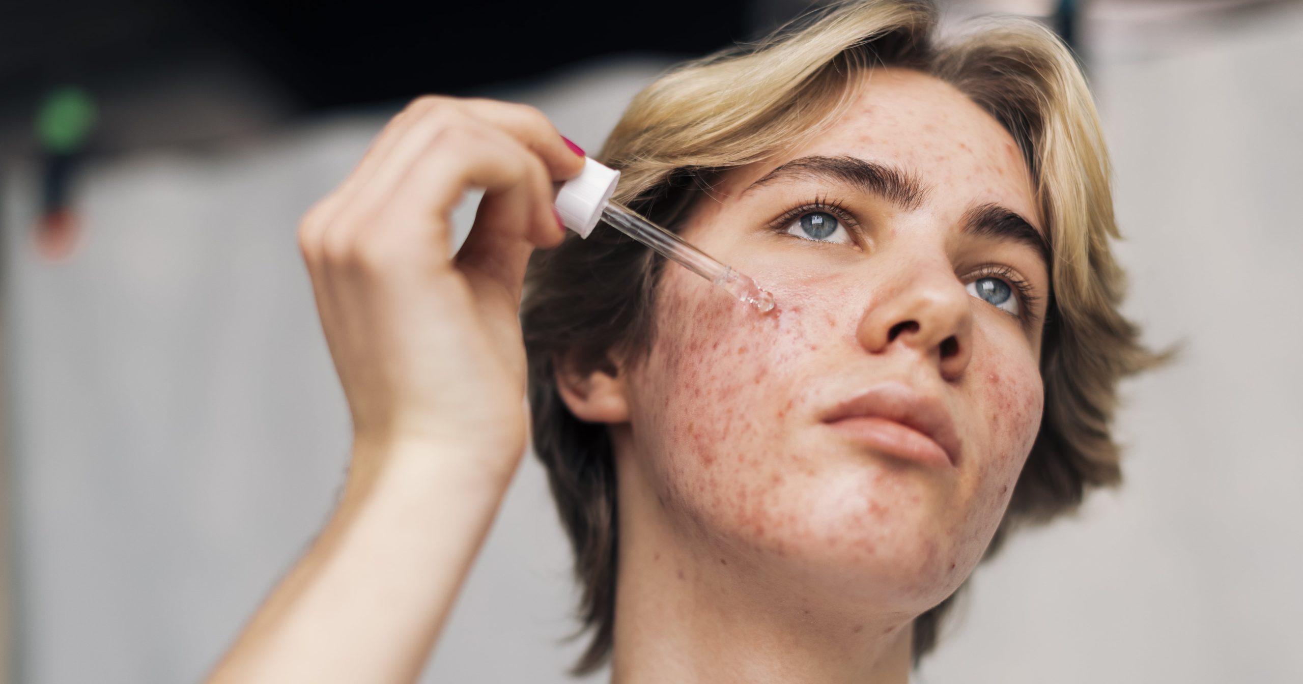 How to Treat Pimples Under the Skin That Won't Go Away