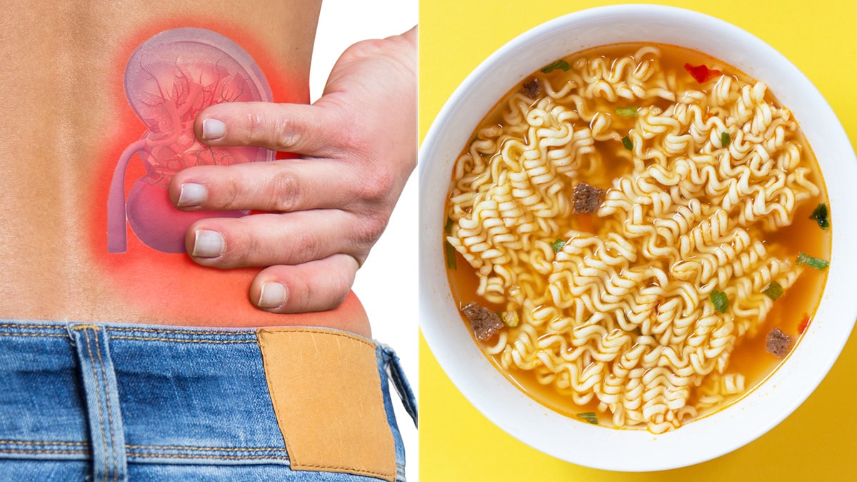 Can Eating Ramen Noodles Lead To Kidney Stones? Doctors Explain Dietary Risk Factors And Prevention Tips