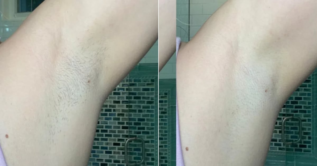 I Tried Ulike's At-Home Hair-Removal Laser