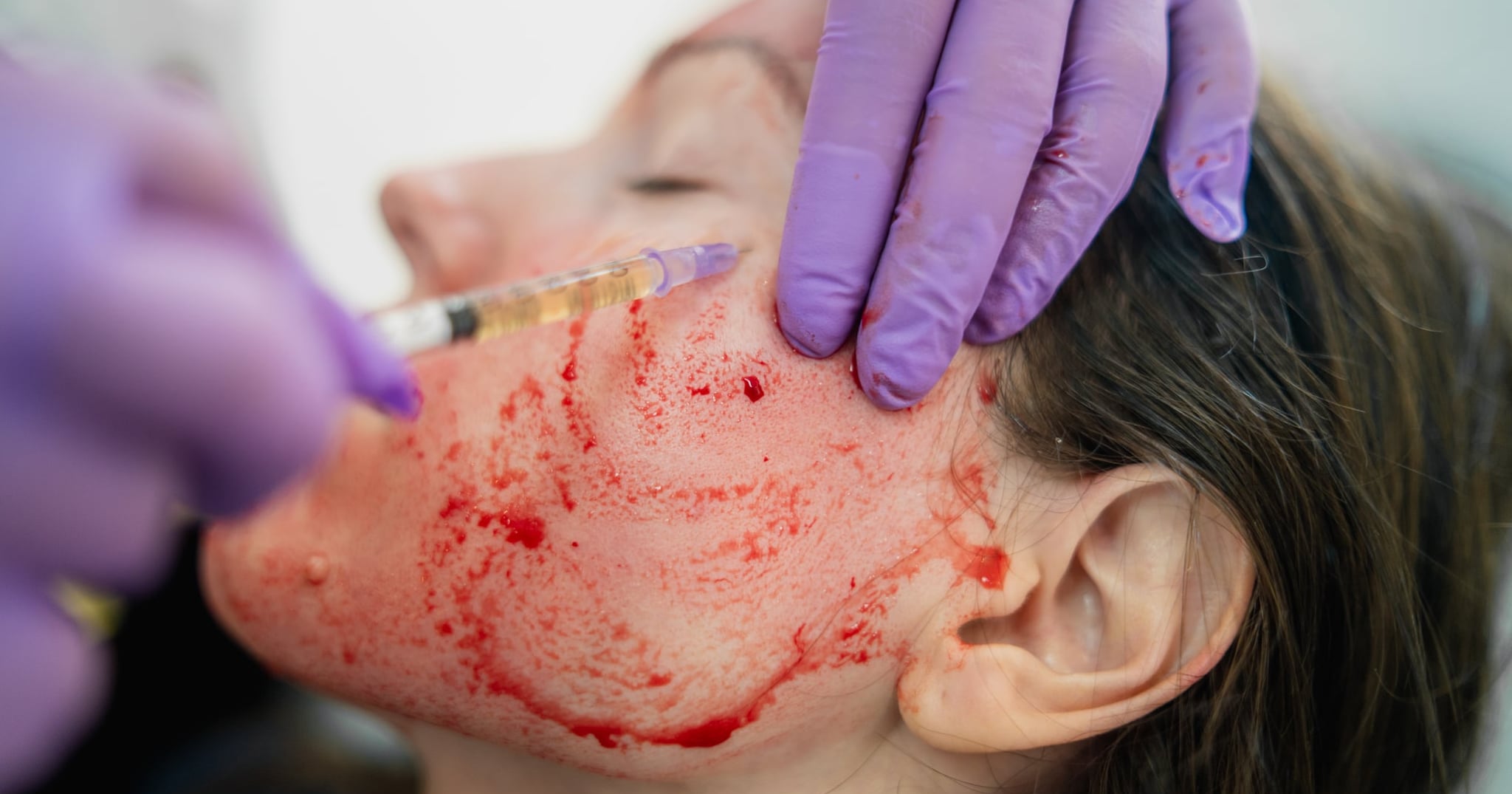 Multiple People Have Been Diagnosed With HIV After Getting a "Vampire Facial"