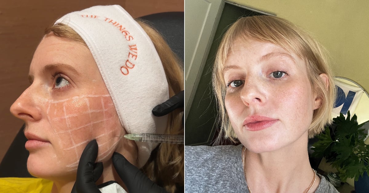 Skinvive Review: I Tried the Buzzy New "No-Filler" Filler