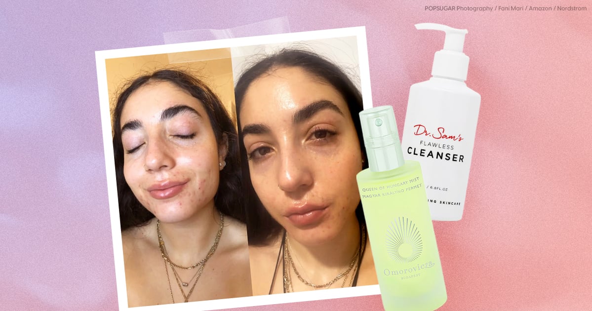 I'm on Accutane, and These Are the Products Saving My Dry Skin