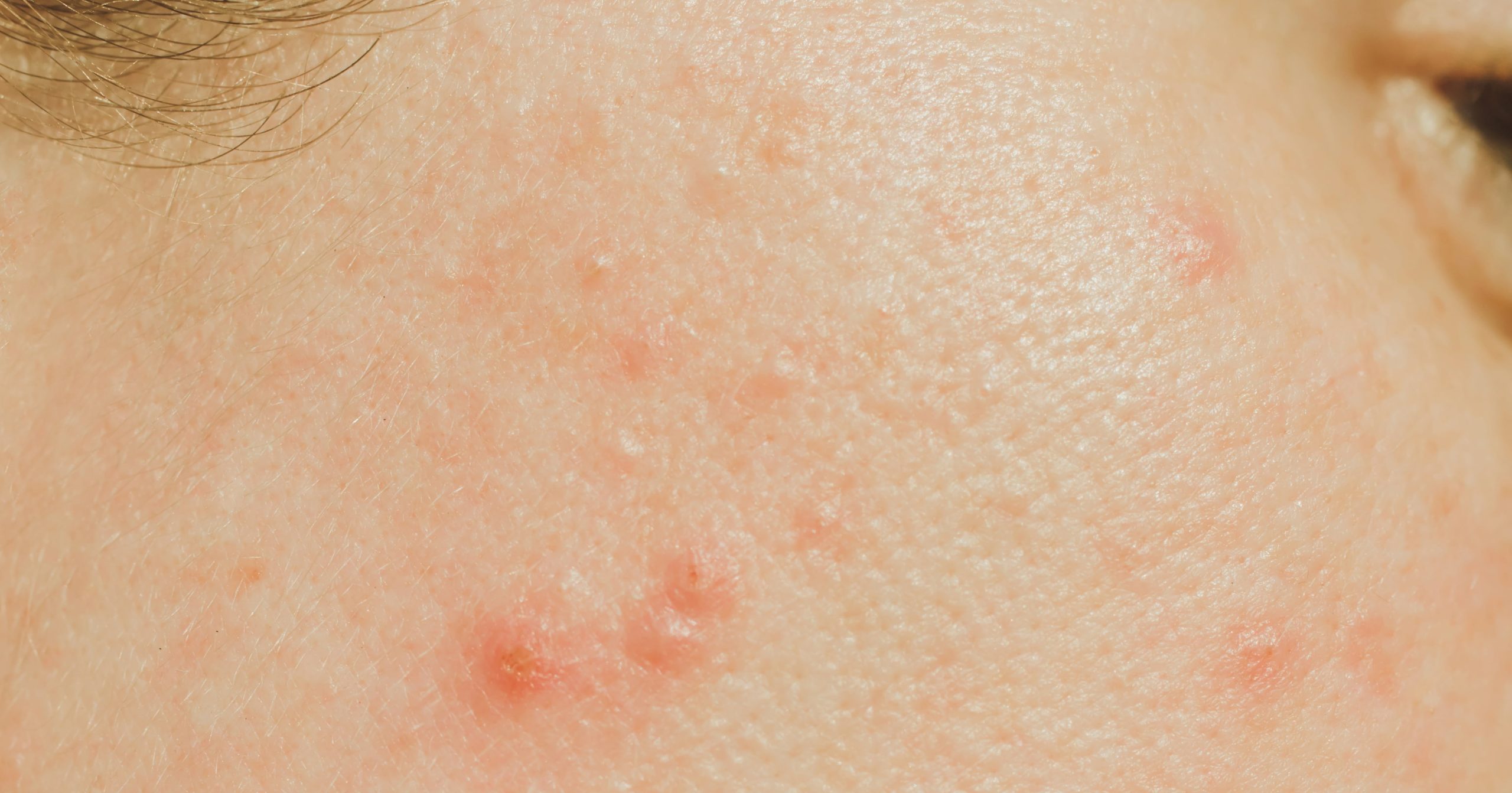 Severe Acne: A Breakdown of Types, Treatments, and More